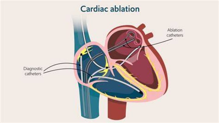 Are you awake when they do an ablation?