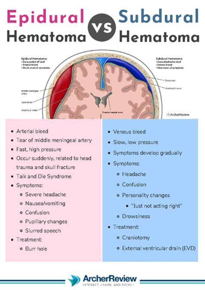 Are you more likely to tear with an epidural?