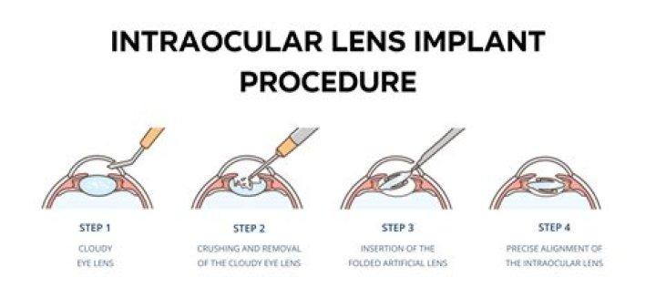 Can a lens implant come loose?