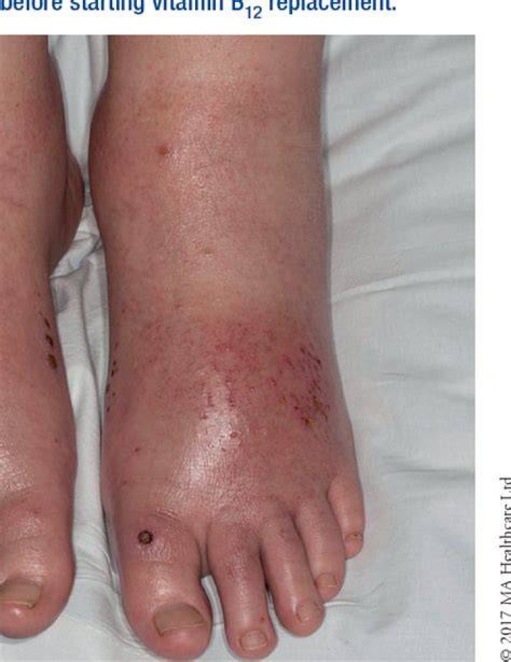 Can lack of B12 cause leg pain?