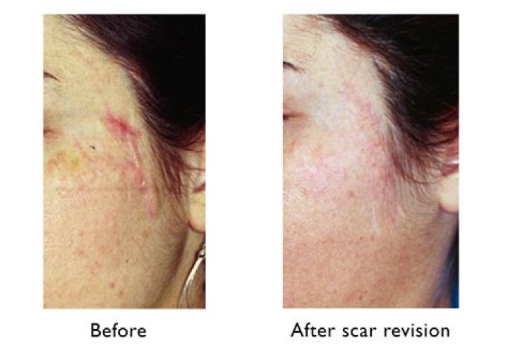 Can scars disappear completely?