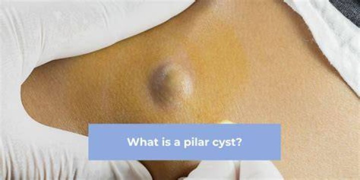 Can you remove a pilar cyst at home?