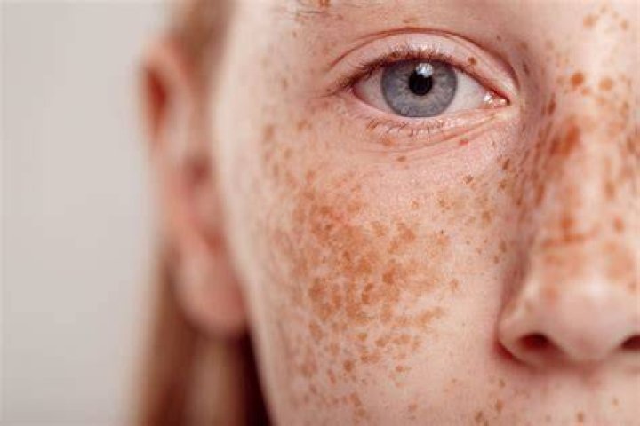 Do freckles get darker when you tan?