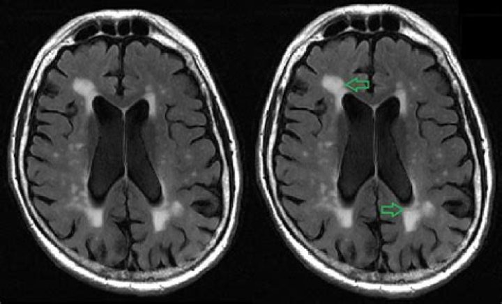 Do white spots on the brain mean dementia?