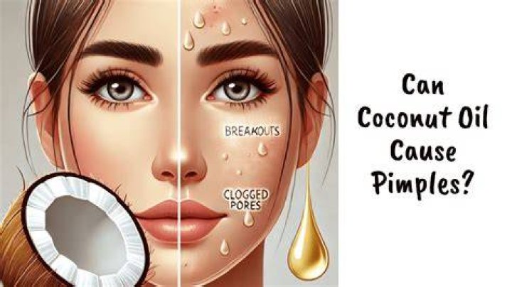 Does coconut oil cause pimples?