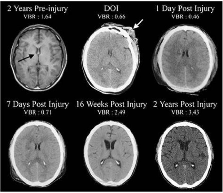 Does MRI damage the brain?