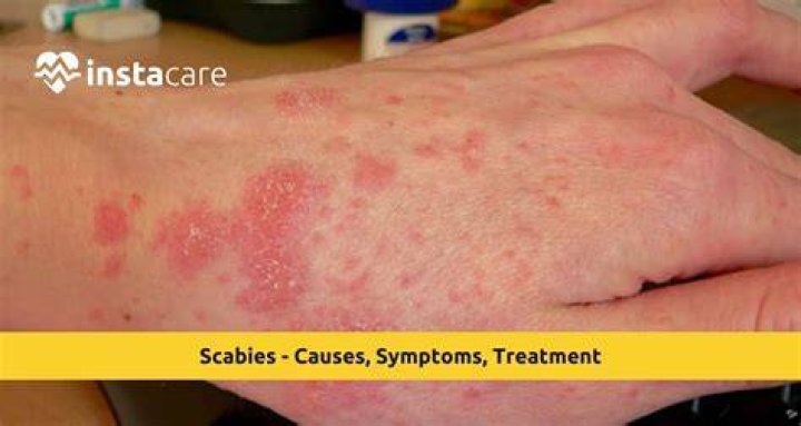 Does the scabies rash always itch?