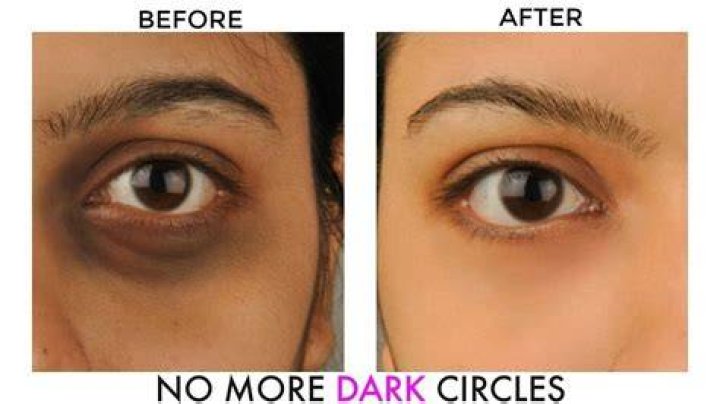 How do you fix dark circles?