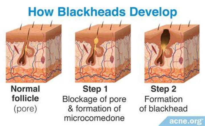 How do you pop a blackhead under your eye?
