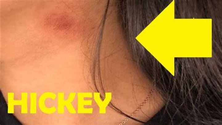 How do you rub a hickey?