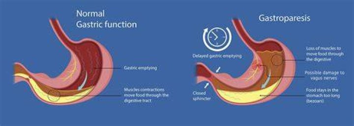 How is gastric paralysis treated?