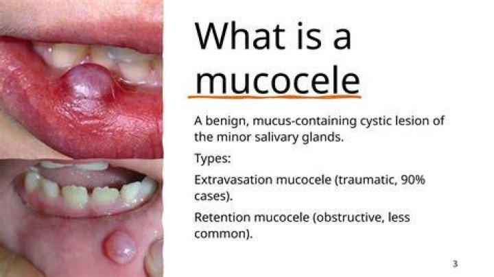 What does a mucocele look like?
