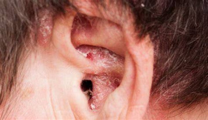 What does eczema look like on ears?