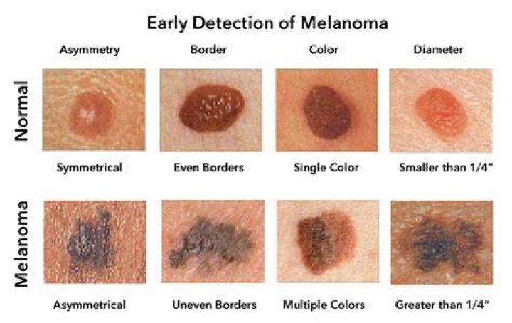 What does the beginning of melanoma look like?