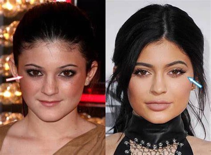 What eye surgery did Kylie?