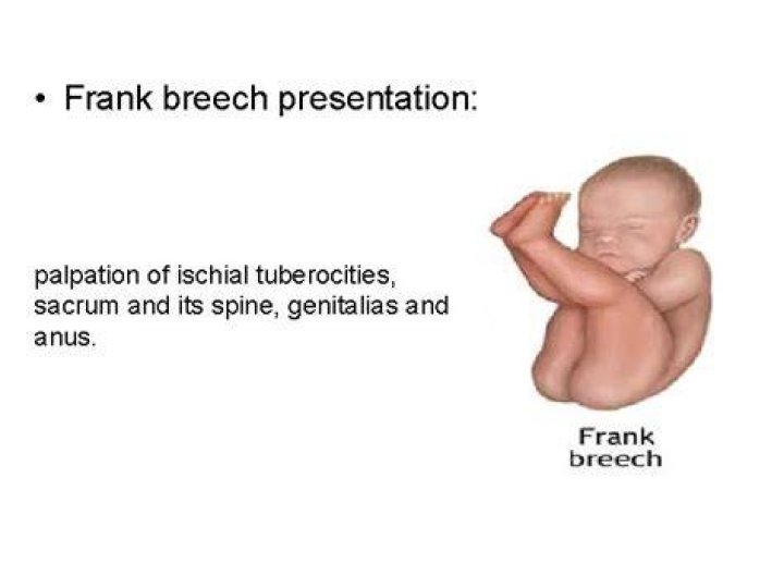 What is frank breech mean?