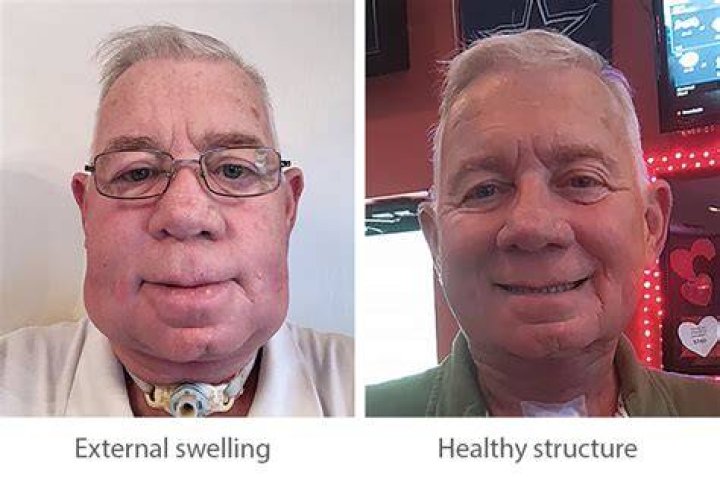 What is lymphedema in the neck?