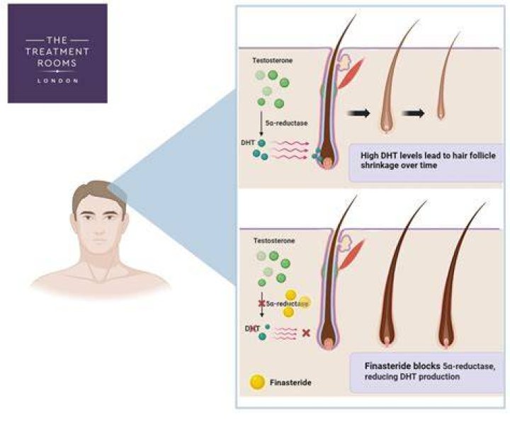 What removes DHT from scalp?