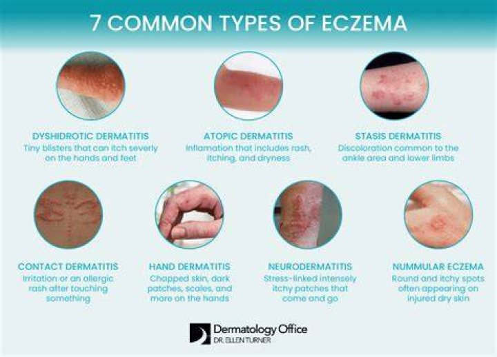 What weather is best for eczema?