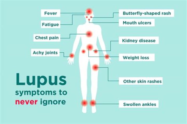 Where is lupus pain?