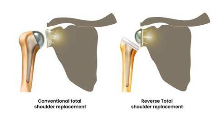 Why is a reverse shoulder replacement better?